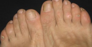 What to do about toe corns