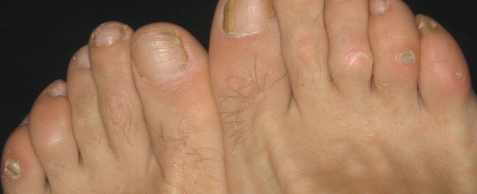 What to do about toe corns