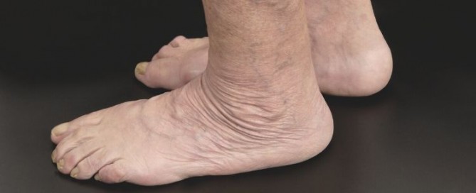 Aging feet