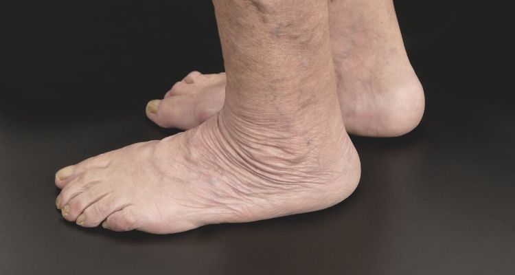 Aging feet changes