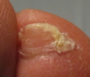 Accessory toenail