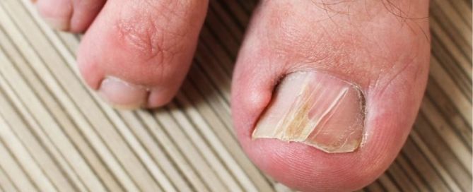 a split toenail