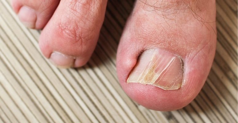 a split toenail