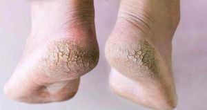 severe heel calluses