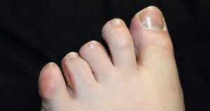 How to hide yellowing toenails
