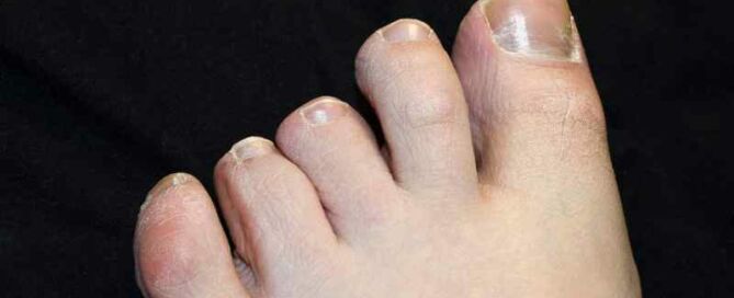 How to hide yellowing toenails